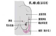 乳腺癌治疗方和预防方