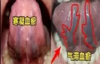 舌下青筋，体内有瘀，千万别活血，小心气绝结节生