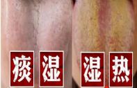 湿气达到这两个阶段，祛湿只是亡羊补牢罢了